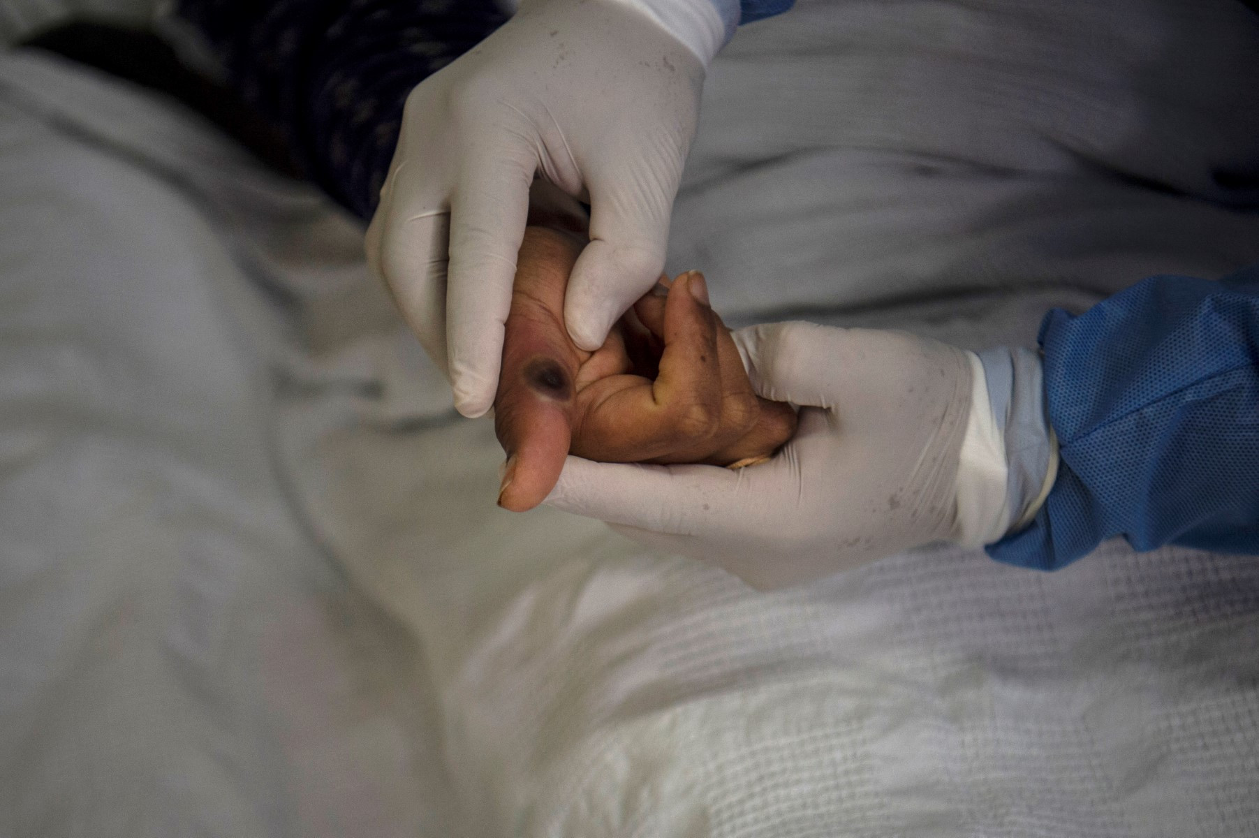Diario Frontera, Frontera Digital,  Salud, ,Viruela del mono: Venezuela anuncia un plan de vigilancia epidemiológica